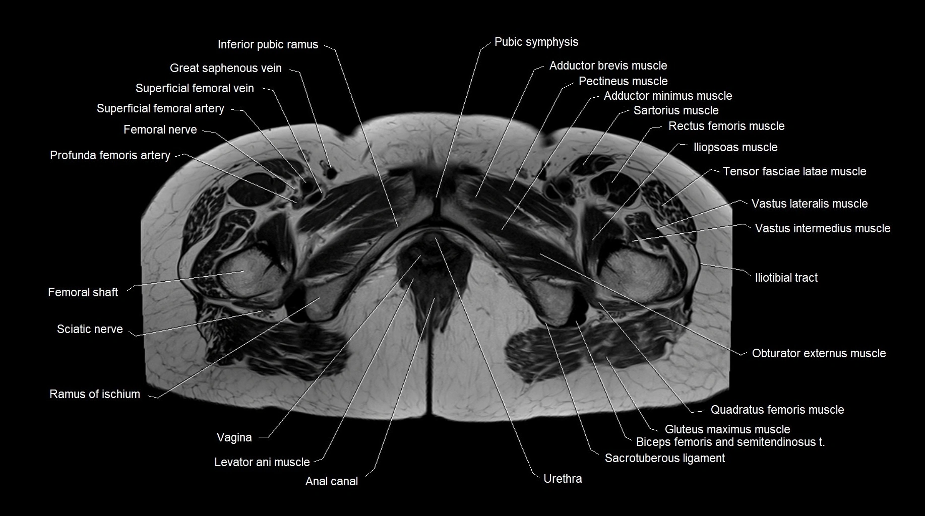 MRI 3T pelvis axial cross section anatomy image 30.webp